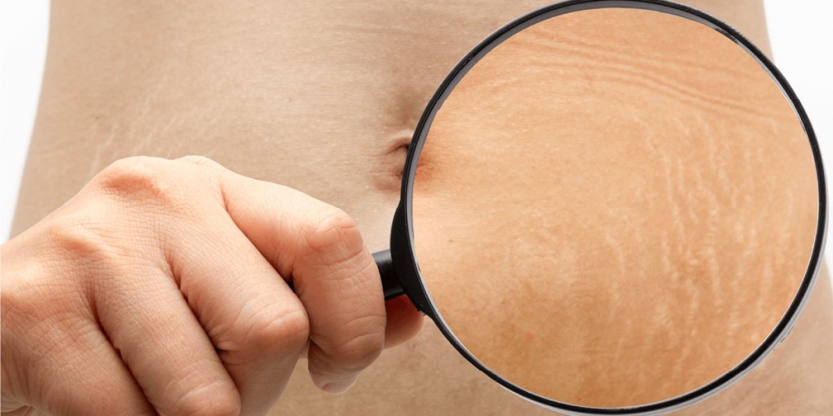 How Laser Stretch Marks Treatment Can Transform Your Skin Fast