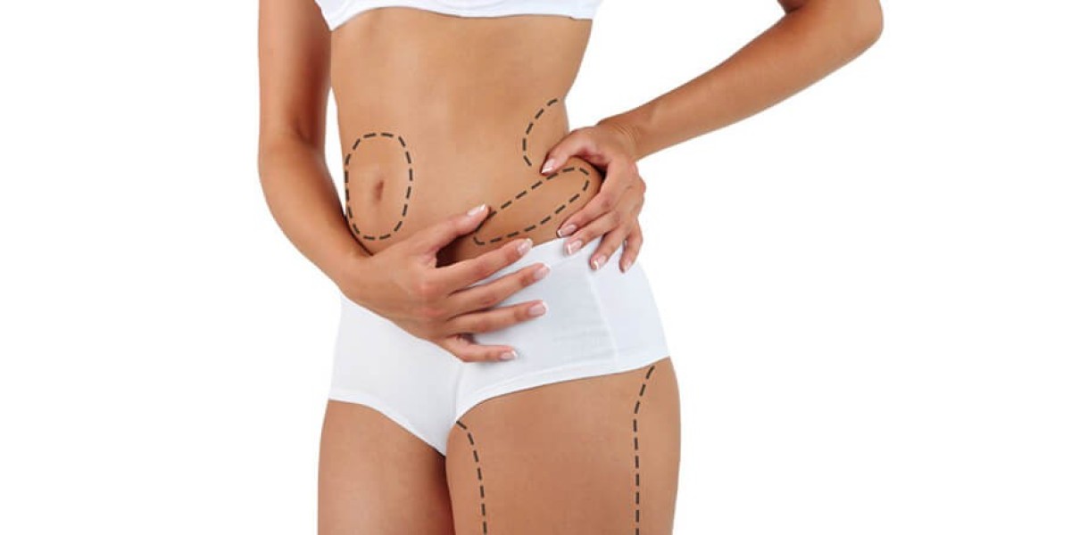 Liposuction for Men in Islamabad: A Rising Trend