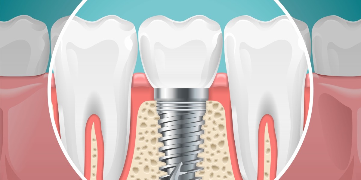 Discover the Freedom of a Secure Smile with Dental Implants Today