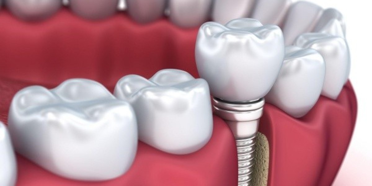 Quy trình trồng răng implant: Hướng dẫn chi tiết từ bác sĩ chuyên khoa