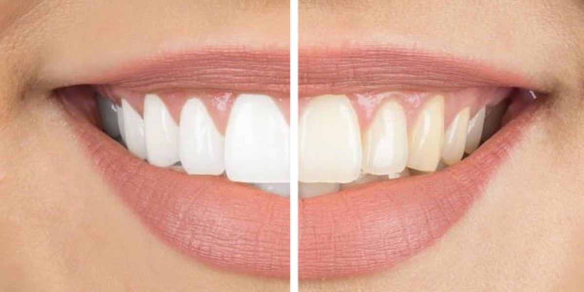 From Dull to Dazzling: What You’ll Pay for Teeth Whitening in Dubai