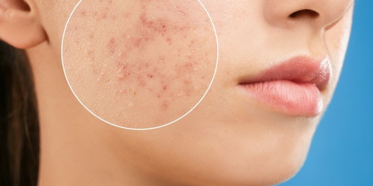 Proven Scar Removal Techniques You Should Try