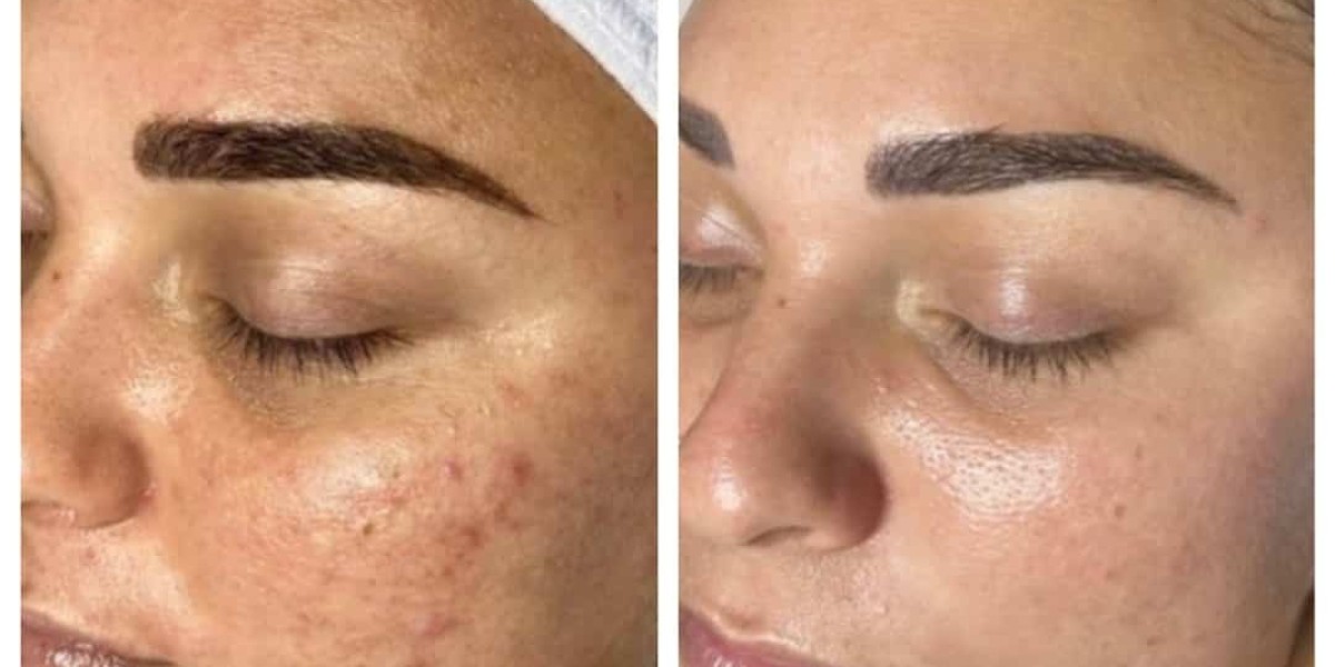 Beat dry skin with hydrafacial therapy in peshawar