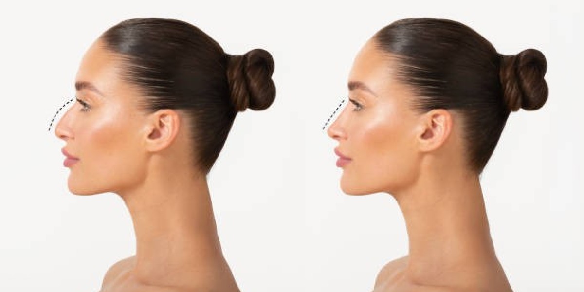 Top Surgeons for Rhinoplasty in Riyadh