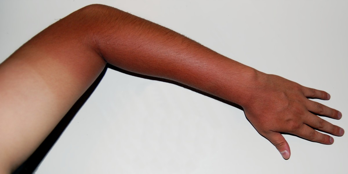 Tan Removal Cream Market: Current Trends, Challenges, and Future Outlook in India’s Skincare Industry