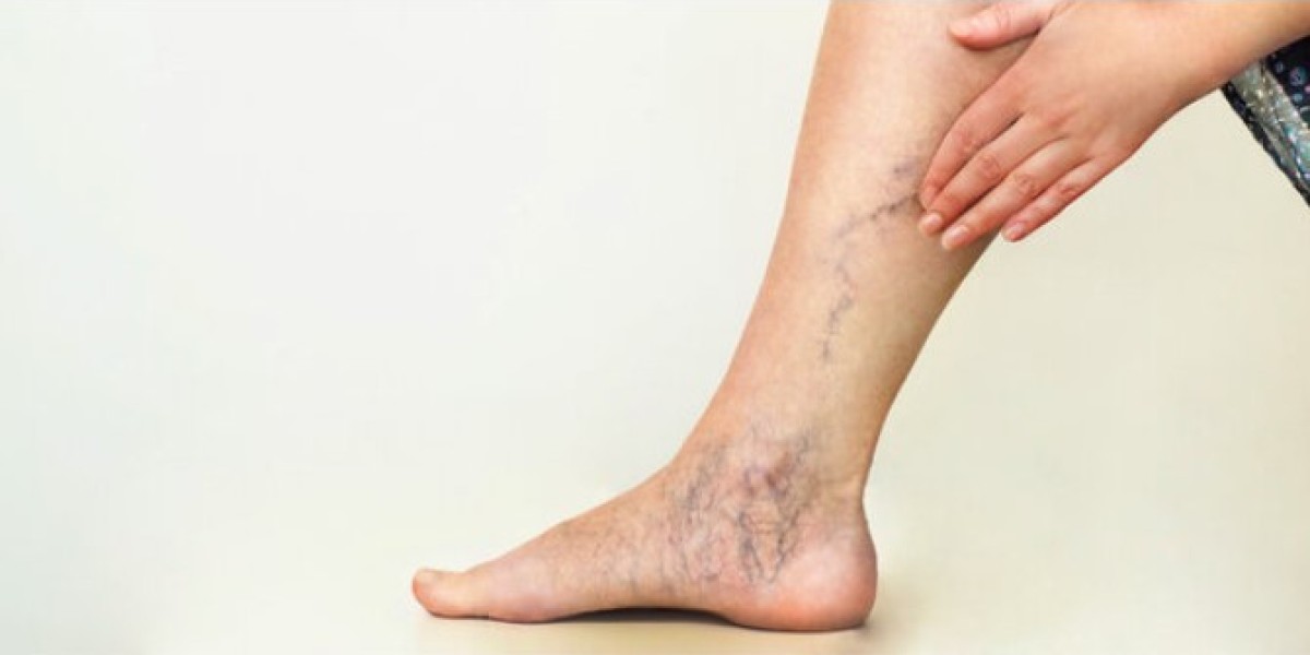 Are Spider Veins Dangerous? When to Seek Treatment in Riyadh
