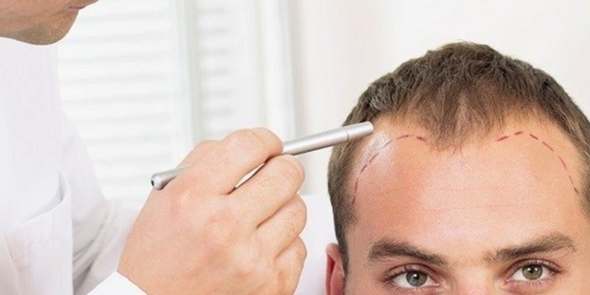 What Is a Hair Transplant?