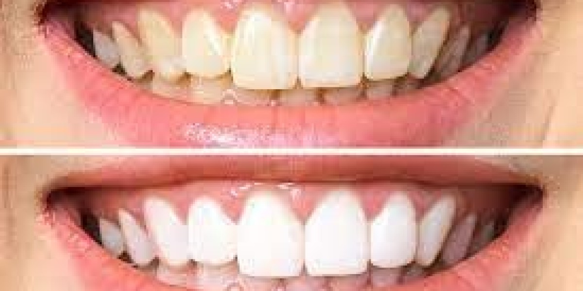 Budget-Friendly Teeth Whitening in Dubai