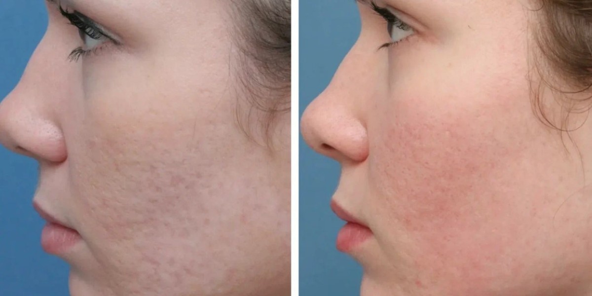 Riyadh’s Most Trusted Clinics for Acne Scar Laser Treatment