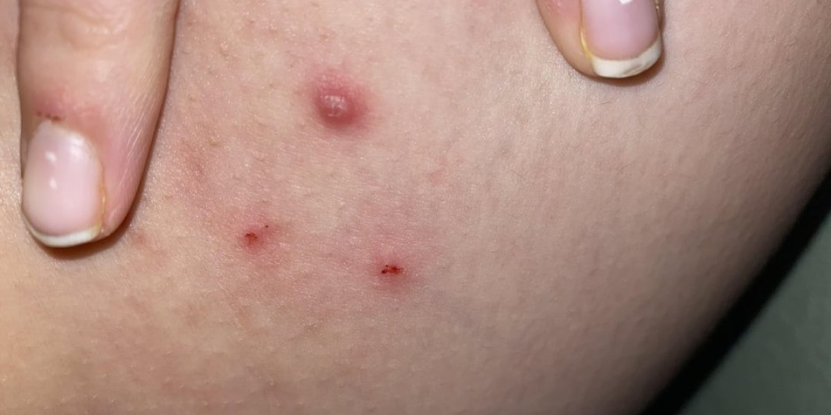 How to Use Salicylic Acid Properly to Help Remove Warts