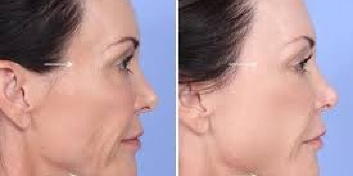 Discover the Benefits of Sculptra in Miami