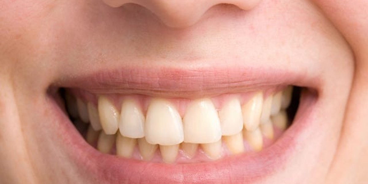 Teeth Whitening: Is It Affordable?