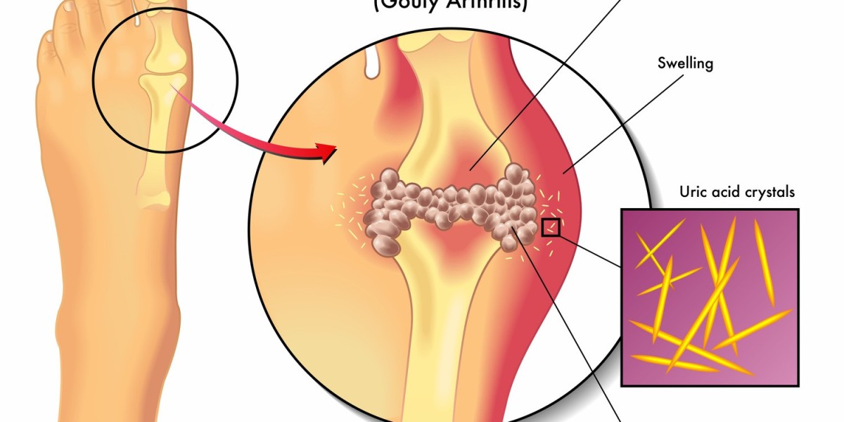 Global Gout Therapeutics Market Forecast: Size, Share & Innovation Outlook in Drug Development