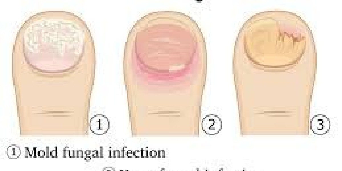 best nail fungus treatment otc