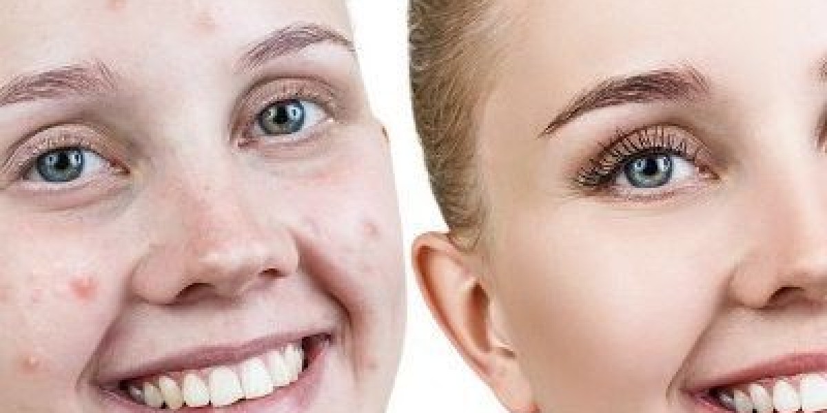 The Different Types of Acne Explained