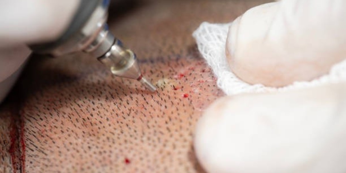 Hair Transplant in Dubai: Cost, Clinics, and Quality
