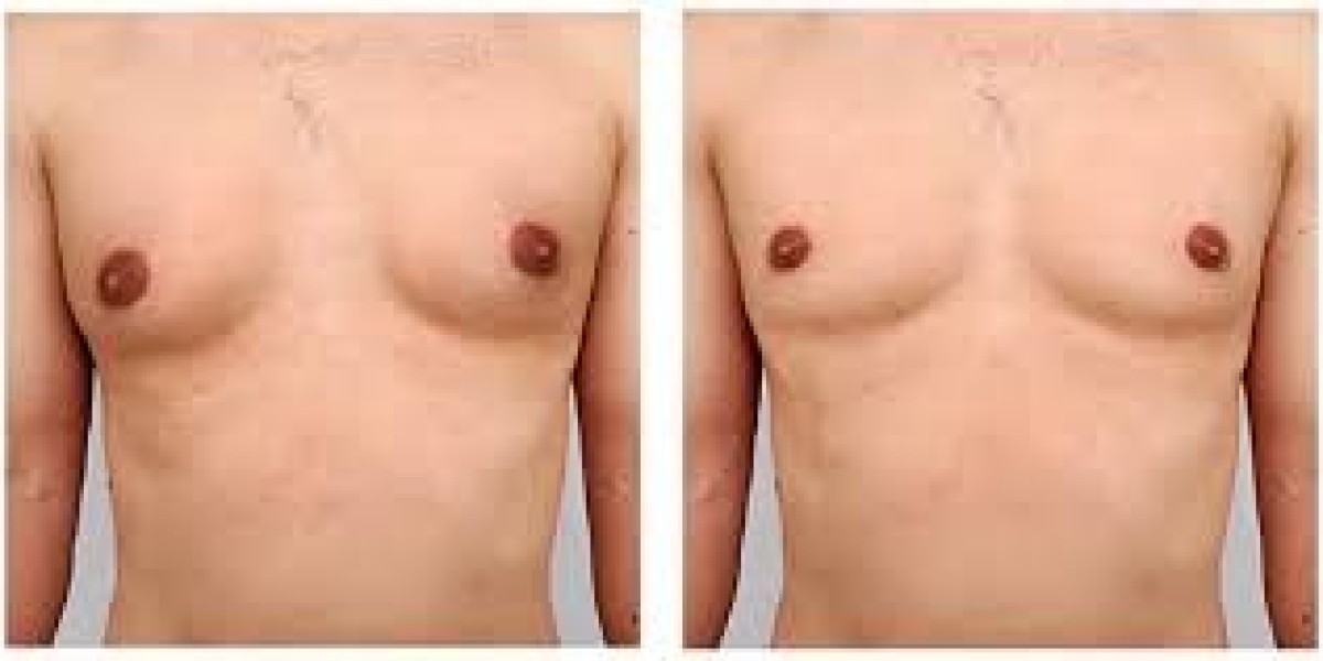 Explore the Top Reasons to Choose Gynecomastia Surgery