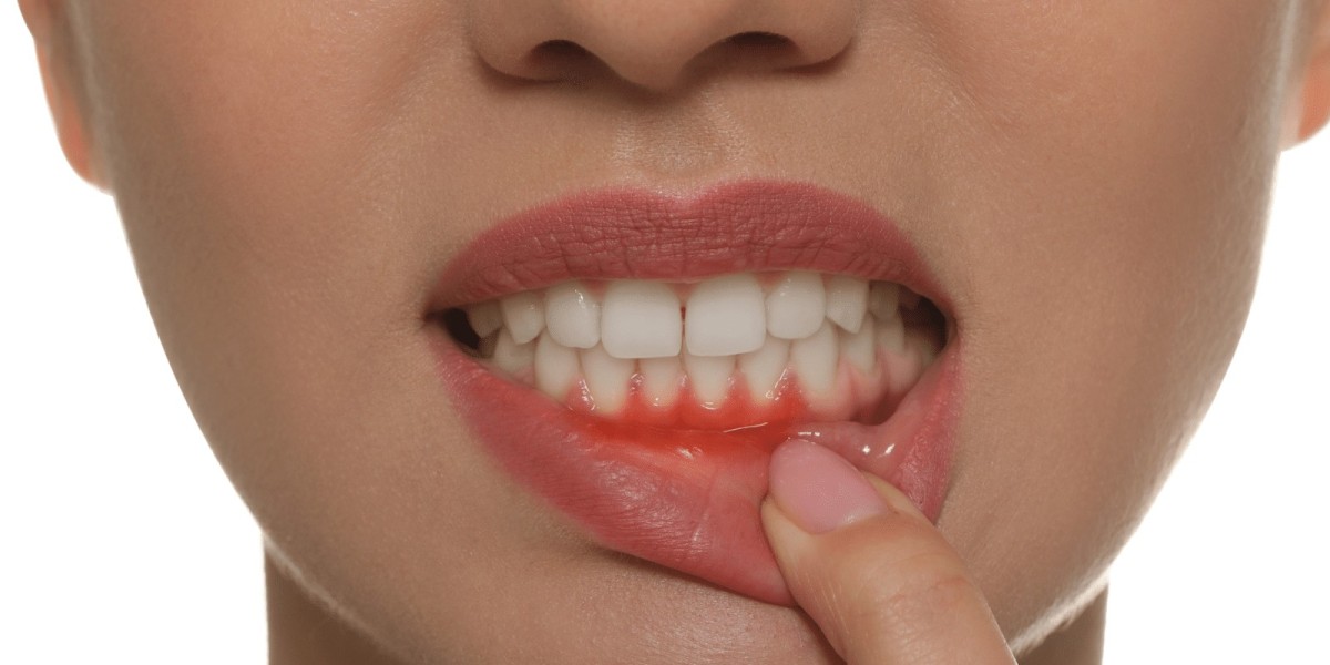 Do the Results of Gum Depigmentation Last Forever?