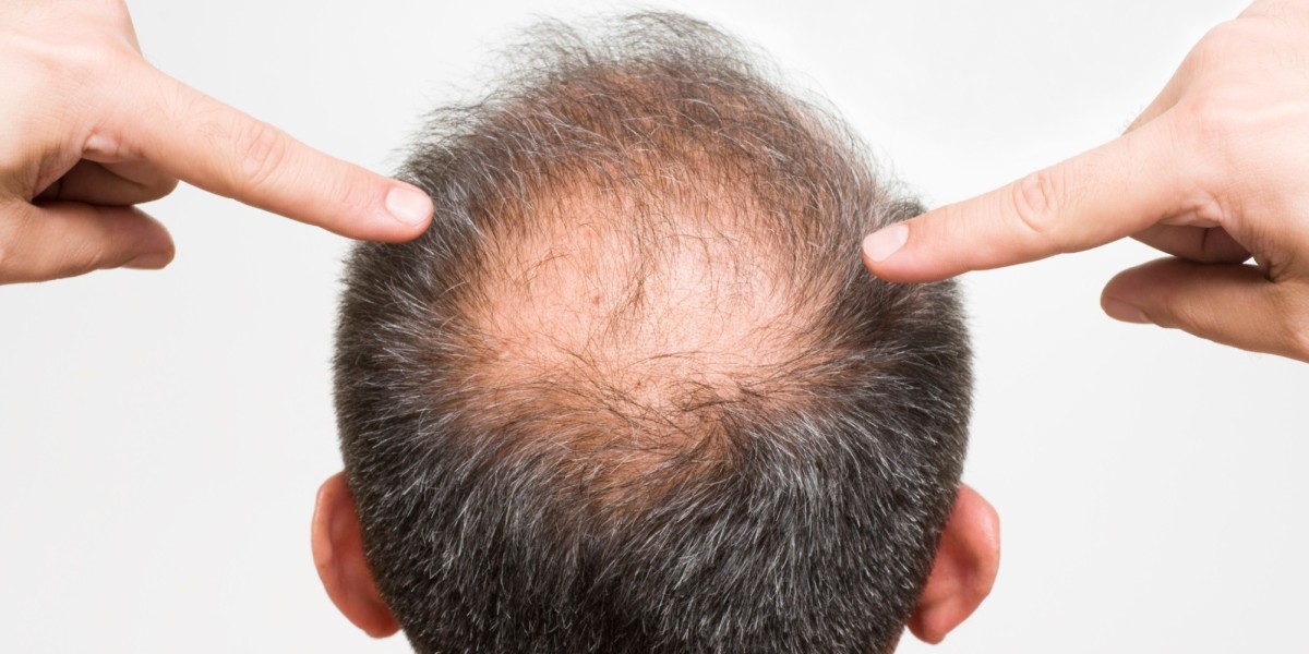Everything You Should Budget For When Considering a Hair Transplant in Islamabad