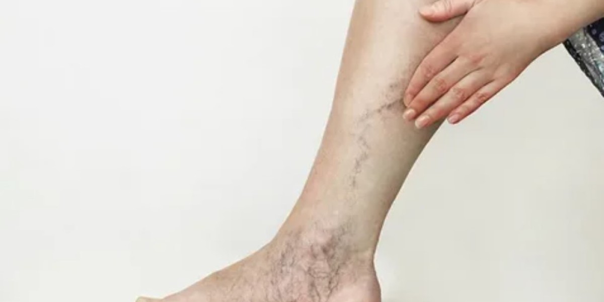 How to Choose a Spider Vein Specialist in Riyadh