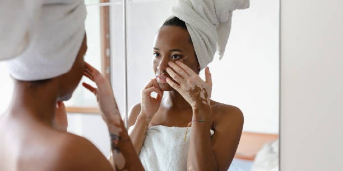 Mumbai Vitiligo Treatment by Dr. Vishal Patel