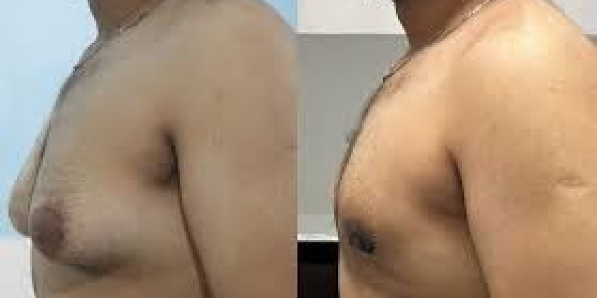 What to Expect During Your Visit to a Gynecomastia Clinic Islamabad