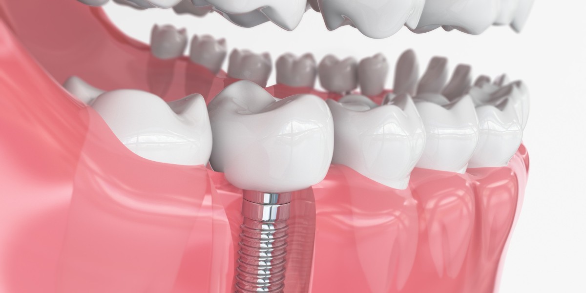 Dental Implants Give You the Smile Freedom You’ve Always Desired