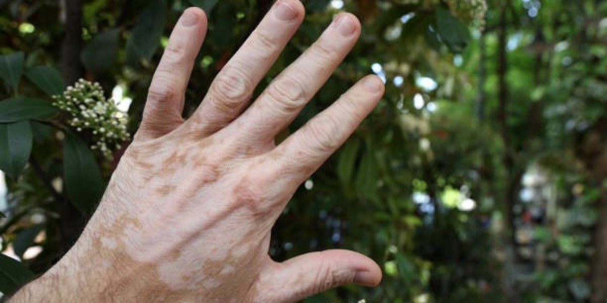 Mumbai Vitiligo Treatment by Dr. Vishal Patel