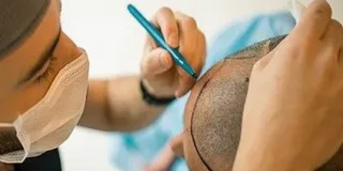 Avoiding Infection After Hair Transplant Surgery in Islamabad