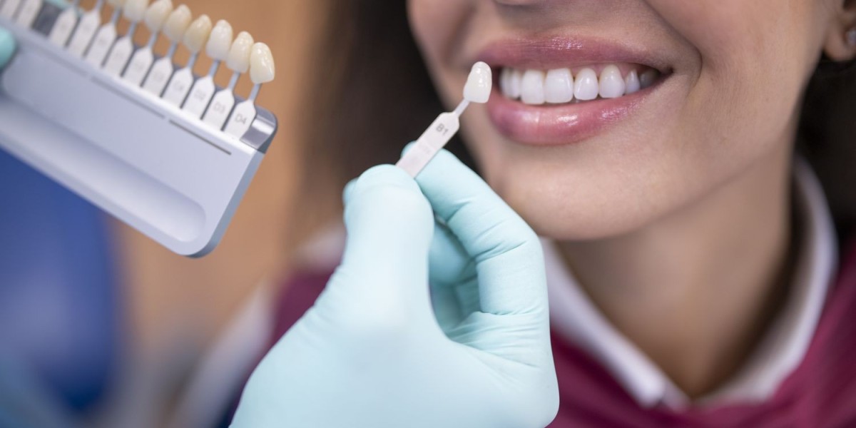 Are Veneers Reversible? Islamabad Dentists Answer