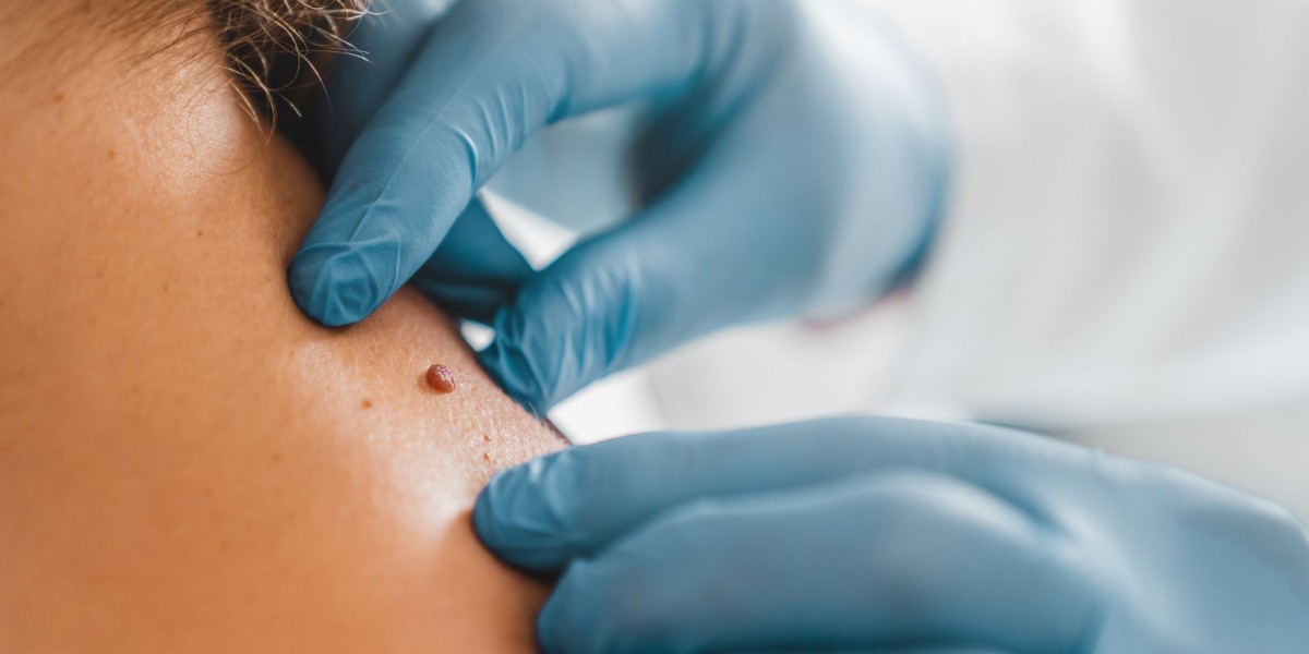 How to Handle Skin Tag Removal Aftercare: Tips for a Smooth Recovery