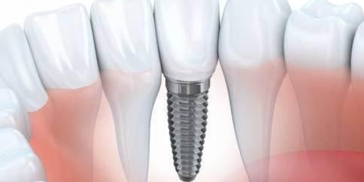 Dental Bone Graft Substitute Market: Reshaping the Future of Oral Regeneration
