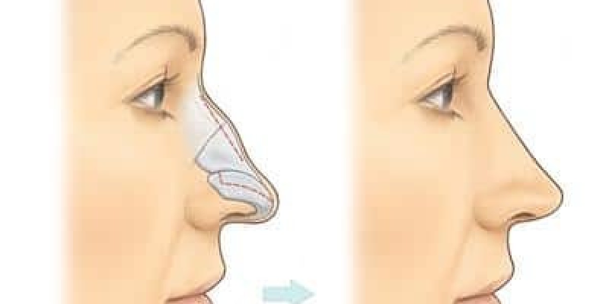 How Rhinoplasty in Islamabad is Enhancing Facial Harmony