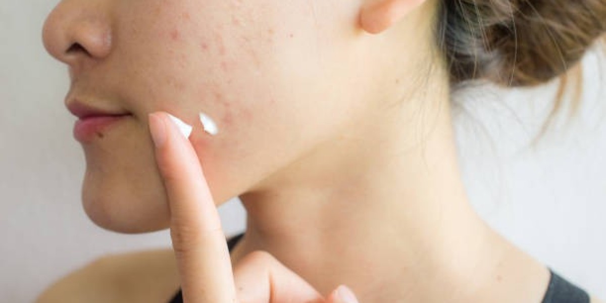 Cost of Pimple Treatment in Dubai: 2025 Update