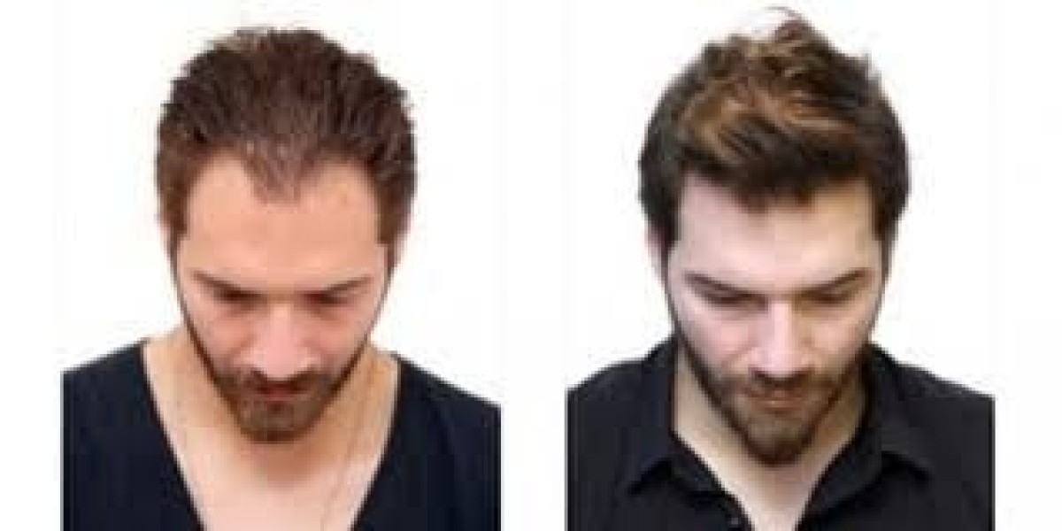 أسئلة شائعة حول زراعة الشعر في دبي: كل ما تحتاج معرفته قبل اتخاذ القرار