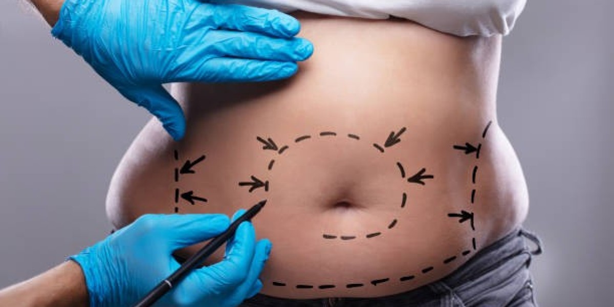 Get a Flatter Stomach with Tummy Tuck in Riyadh