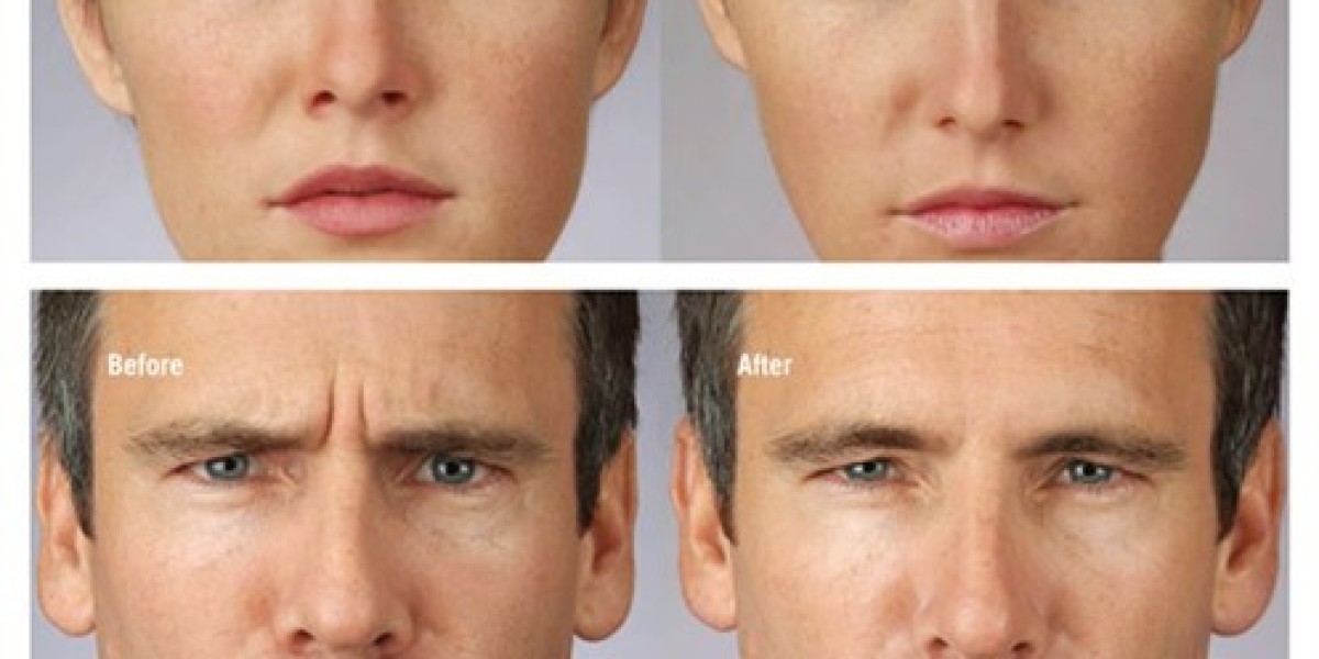 Say Goodbye to Worry Wrinkles: The Best Frown Line Treatment Options in 2025