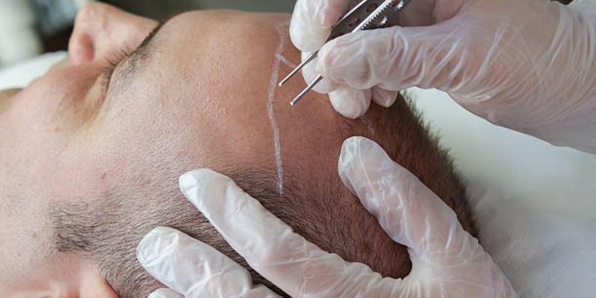 Hair Transplant Dubai Before & After