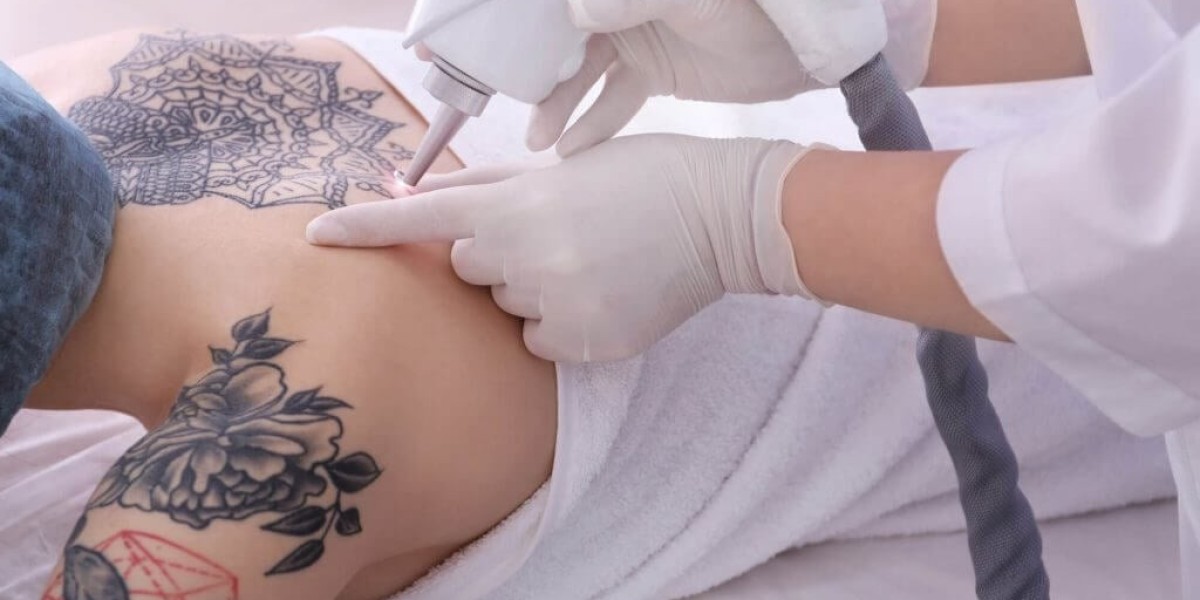 Laser Tattoo Removal Solutions For Completely Clear Skin Results