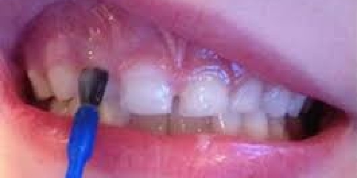 Teeth Desensitizer Market Trends Focus on Product Innovation and Regional Growth Across Emerging Markets