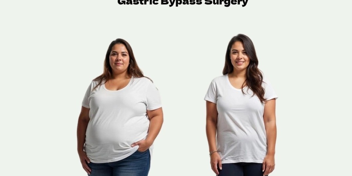 Roux En-Y Gastric Bypass Surgery: A Powerful Tool for Sustainable Weight Loss