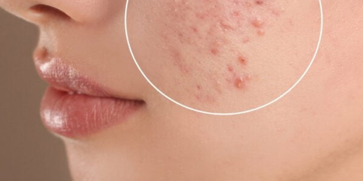 Acne Treatment for Dry Skin: What to Avoid