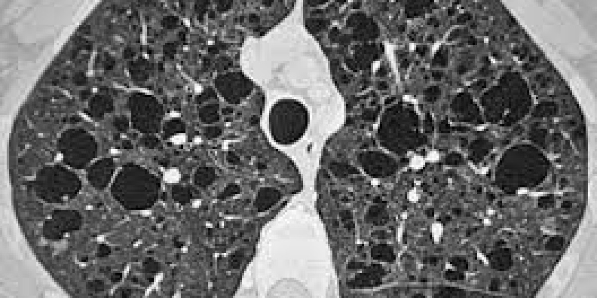 Lymphangioleiomyomatosis Market Size, Epidemiology, Trends, and Forecast 2025-2035