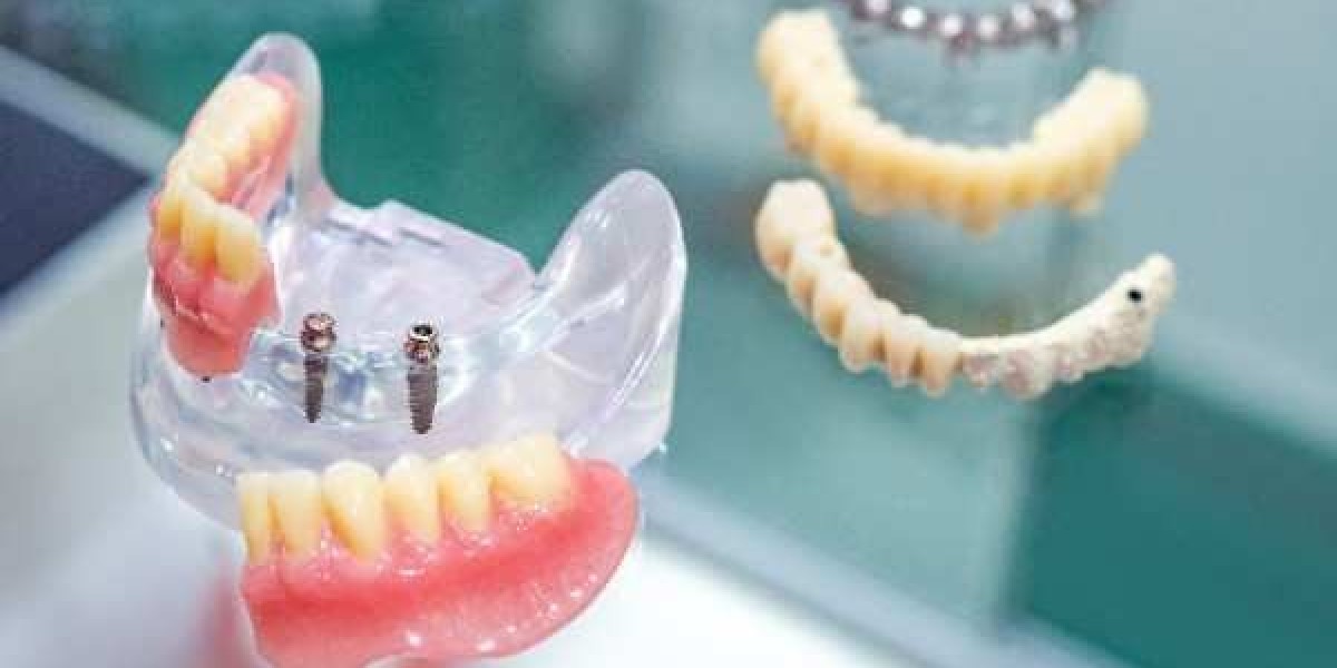 Elite Dental Implants for Natural-Looking, Lasting Results