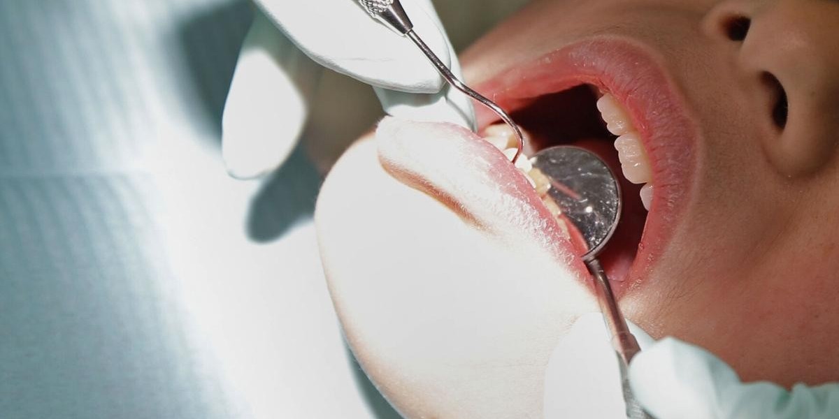 Posterior Root Canals Explained: A Closer Look at Back Tooth Treatment