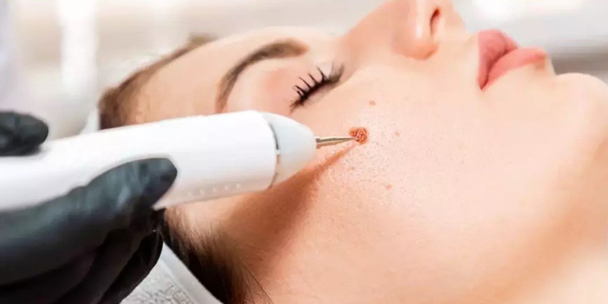 Riyadh Mole Removal: Reviews & Recommendations
