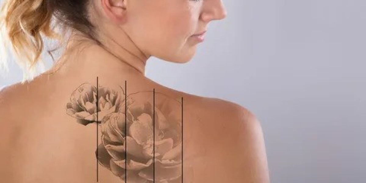 Tattoo Removal for Religious Reasons in Islamabad