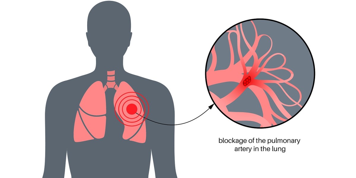 Pulmonary Embolism Market Industry Trends, Share, Size and Forecast 2024-2034
