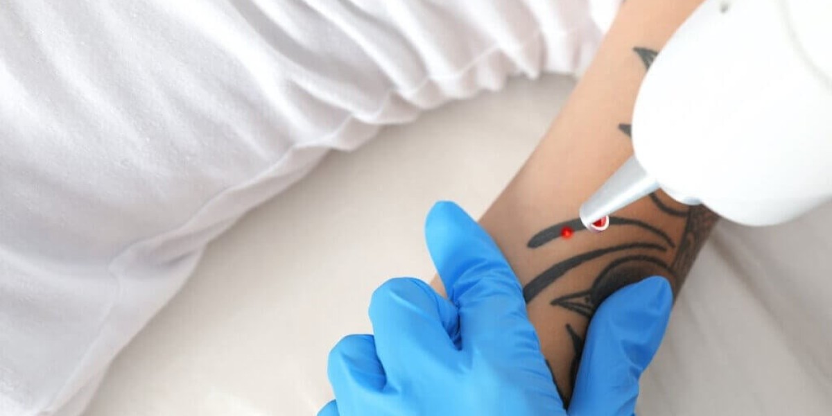 Restore Youthful Skin with Laser Tattoo Removal
