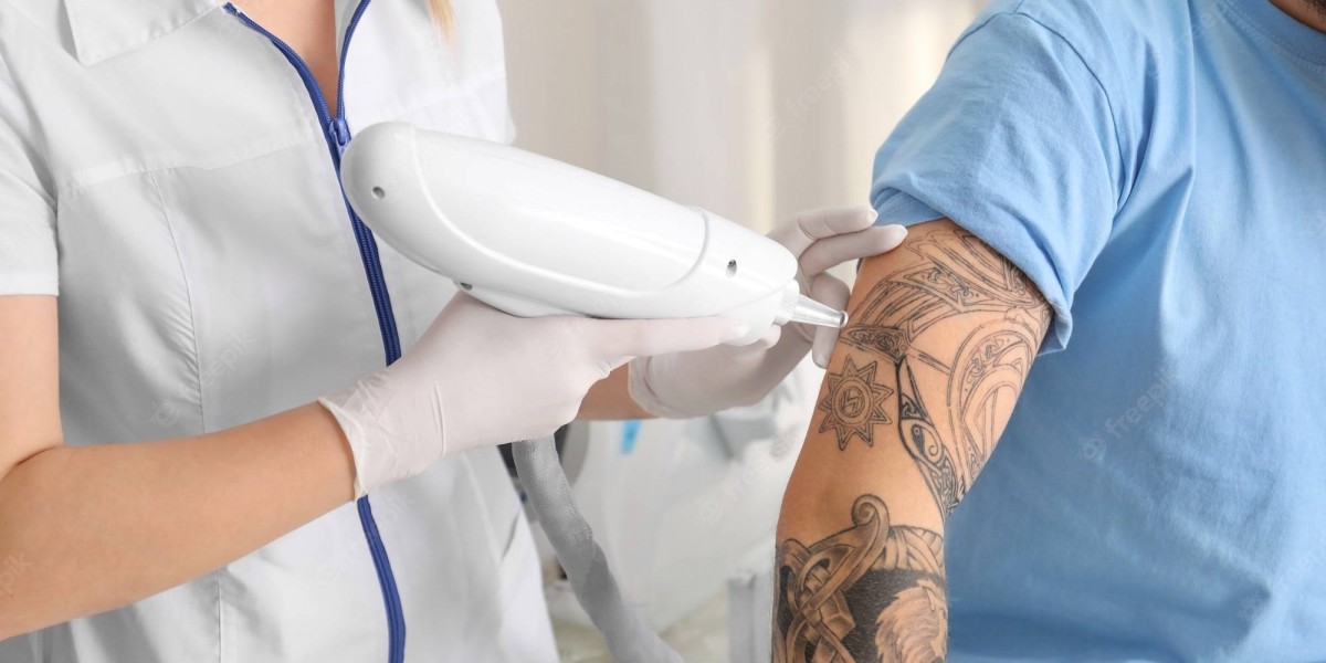 The Best Way to Say Bye to Ink Is Laser Tattoo Removal